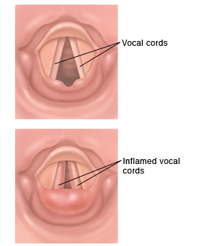 View of normal vocal cords compared to inflamed vocal cords.