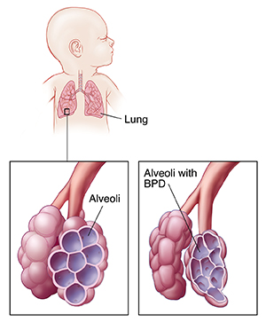 Lungs in newborn's chest, with detail of normal alveoli and of alveoli with BPD.