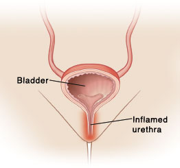 Cross section of bladder with inflamed urethra going from bladder to outside the body.