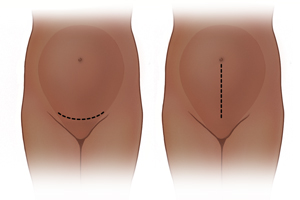 Pregnant abdomen showing low transverse incision. Pregnant abdomen showing midline vertical incision.