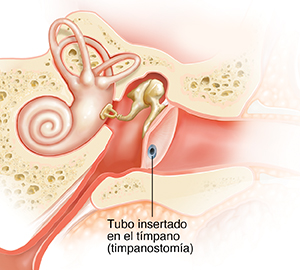 Corte transversal del oído de un niño donde puede verse líquido en el oído medio y la trompa de Eustaquio inflamada, otitis media aguda (OMA). Tubo insertado en el tímpano.